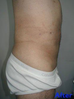 Liposuction