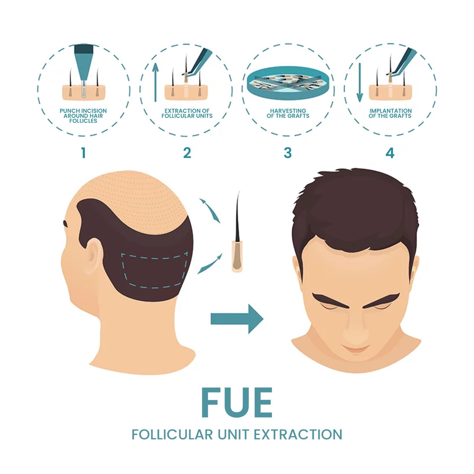 FUE (FOLLICULAR UNIT EXTRACTION)