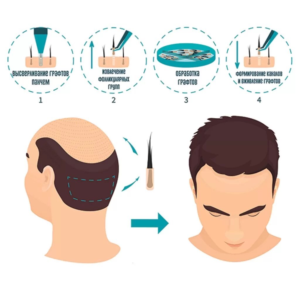 FUE (FOLLICULAR UNIT EXTRACTION)