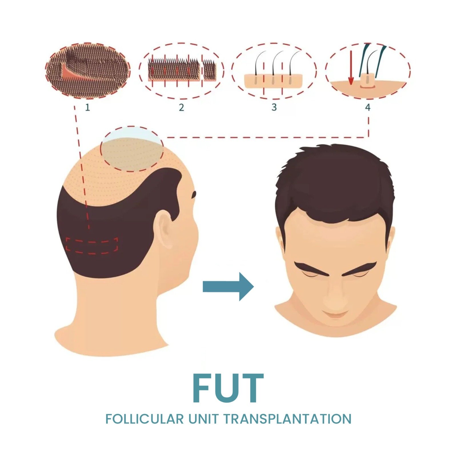 FUT (FOLLICULAR UNIT TRANSPLANT)