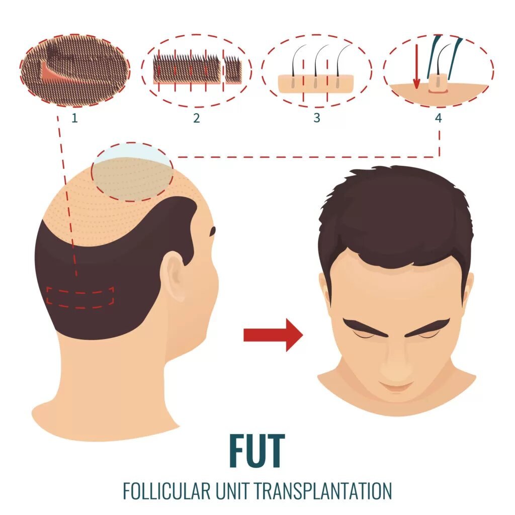 FUT (FOLLICULAR UNIT TRANSPLANT)