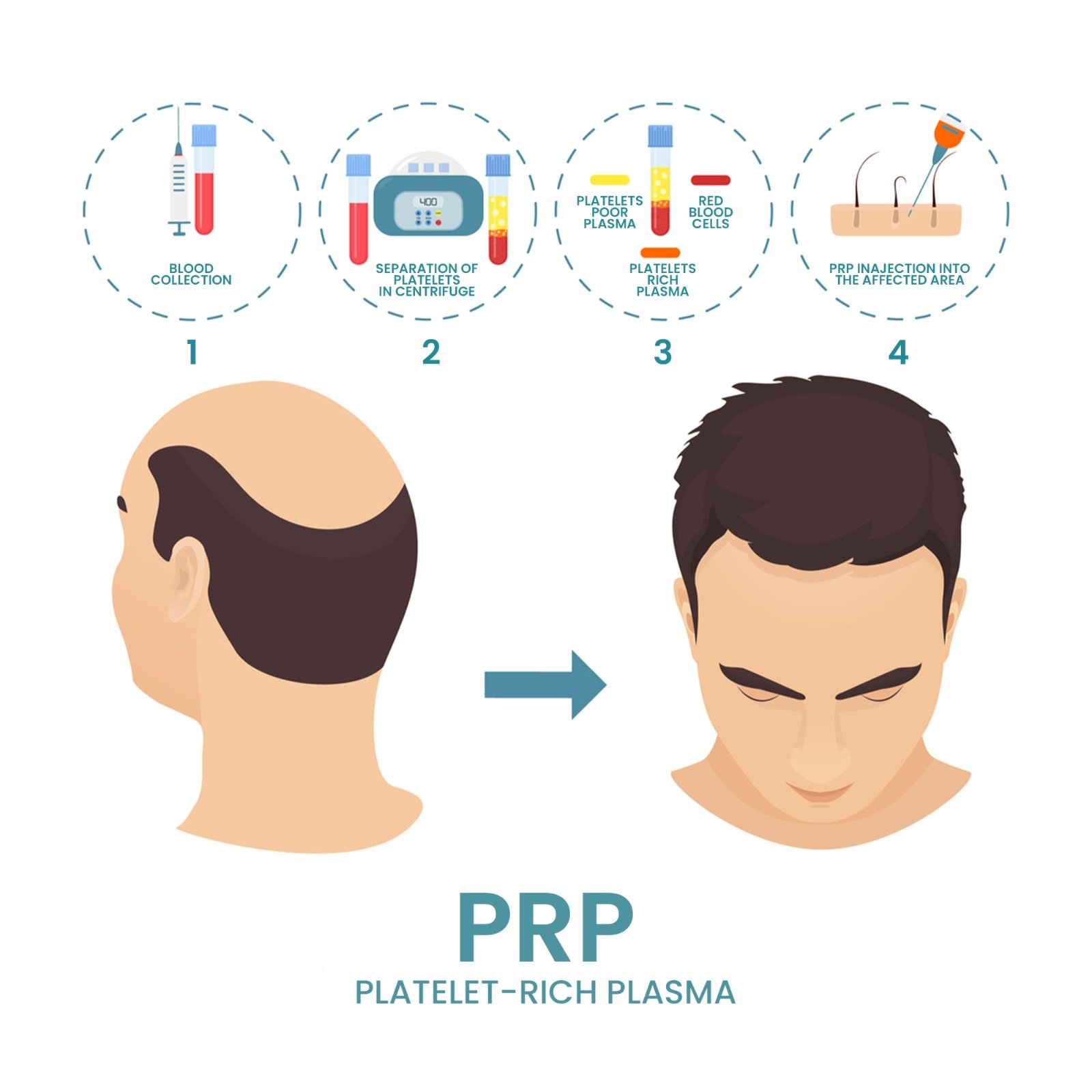 PRP (PLATELET RICH PLASMA THERAPY)