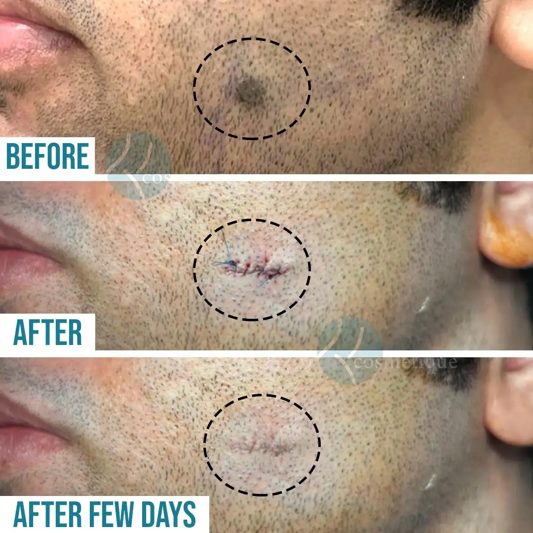Skin tightening and wrinkle reduction before and after HIFU therapy at Institute Cosmetique