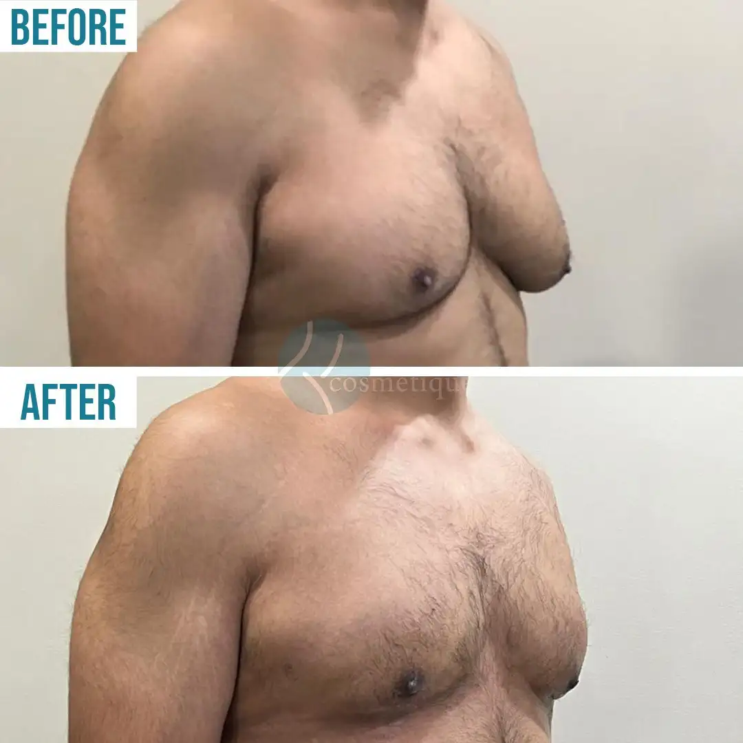 Gynecomastia Before After