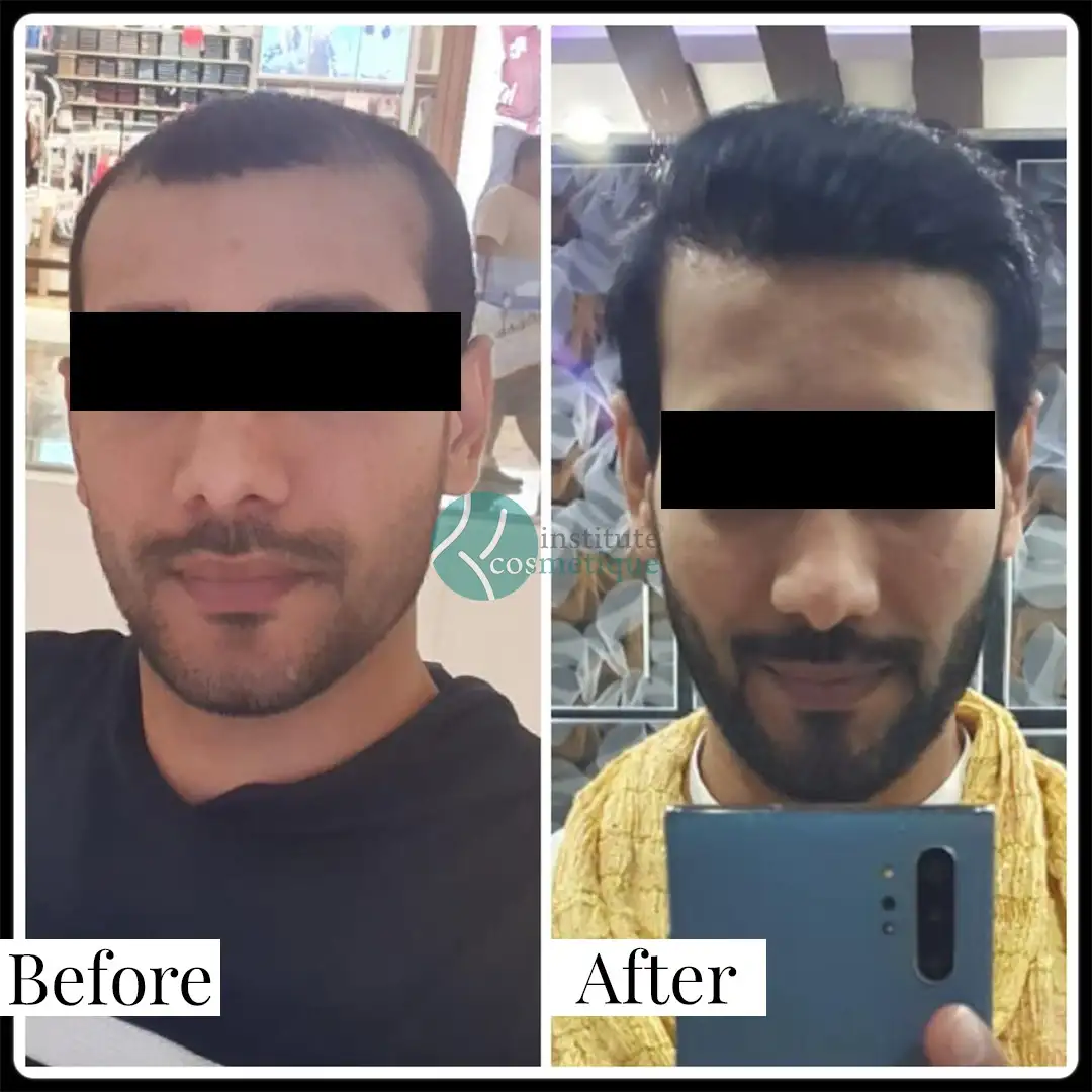 Before and after results of female hairline correction through hair transplant – best hair transplant in Pakistan.