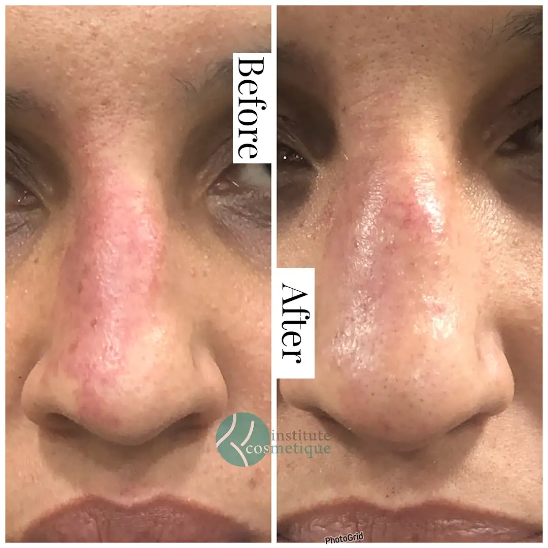 best birthmark removal in Lahore Pakistan