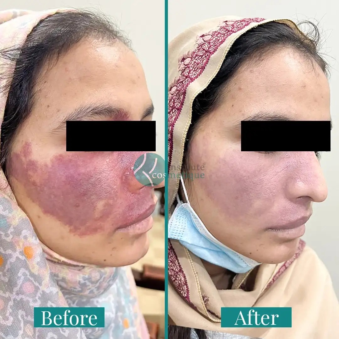 Skin tightening and wrinkle reduction before and after HIFU therapy at Institute Cosmetique