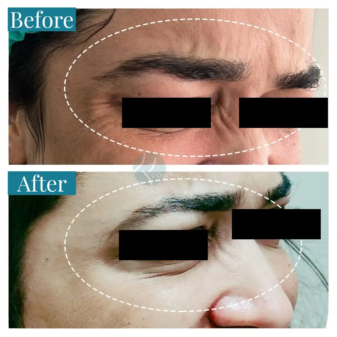 Forehead Botox before and after results - smooth skin, Institute Cosmetique.