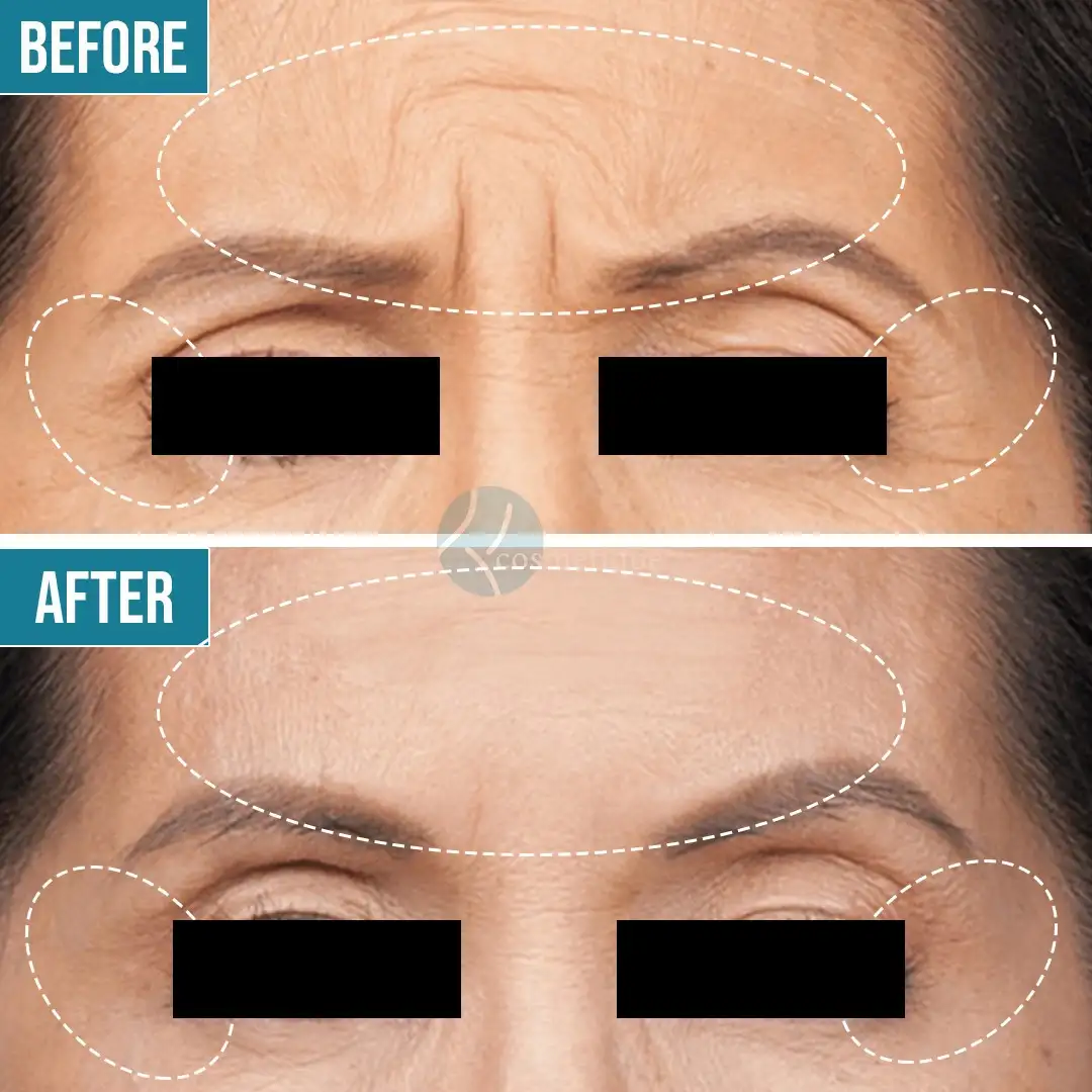 Forehead Botox before and after results - smooth skin, Institute Cosmetique.