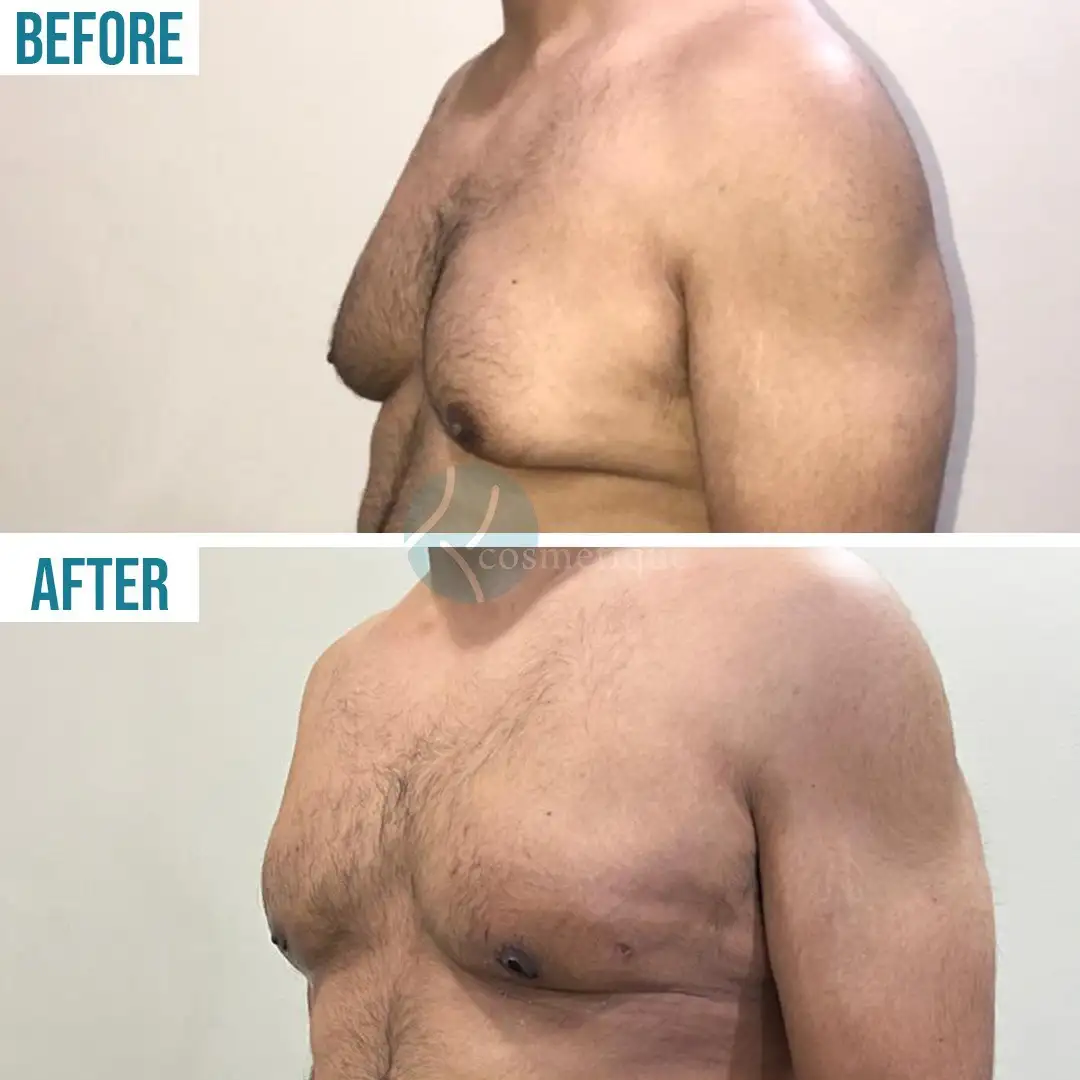 Gynecomastia Before After