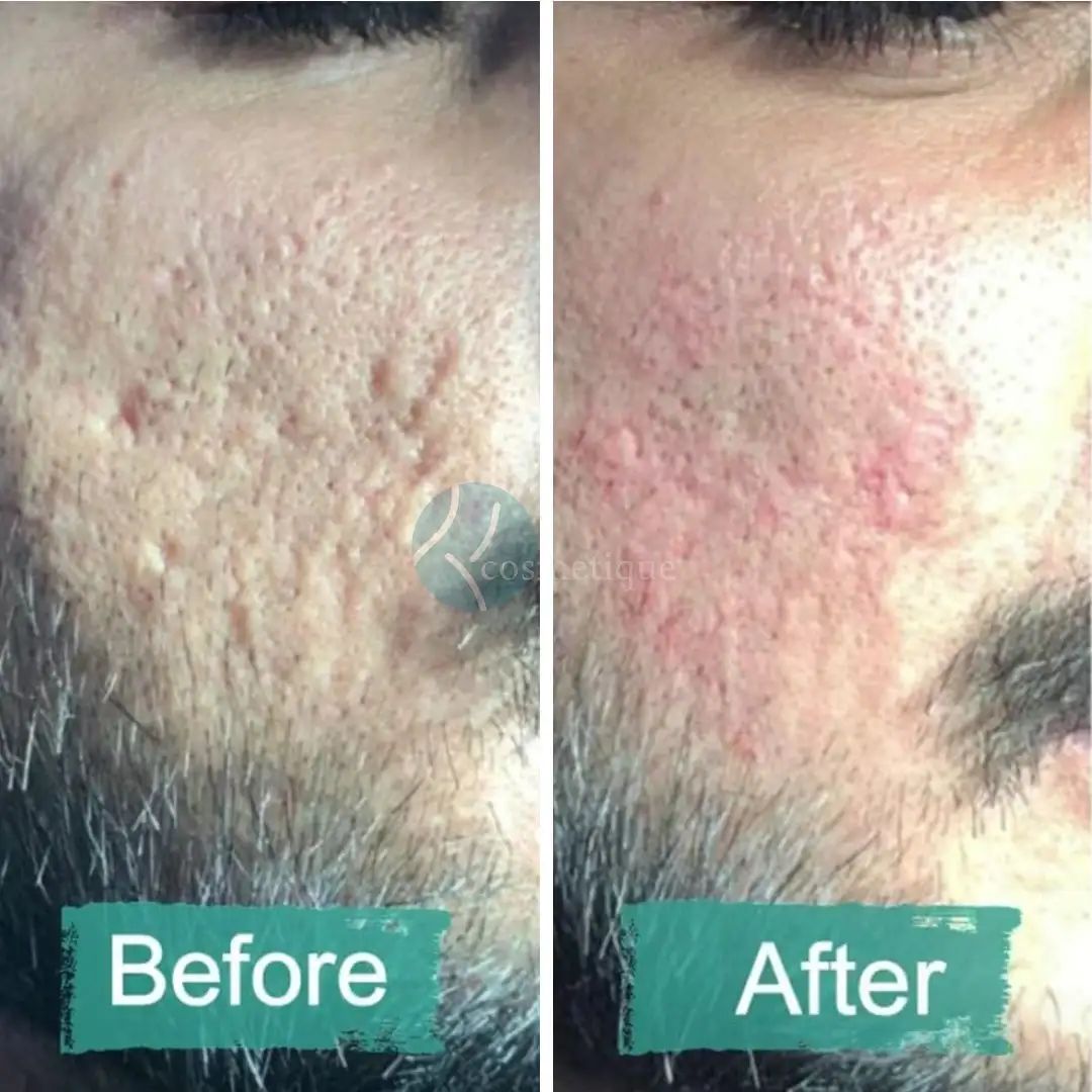 Gynecomastia Before After
