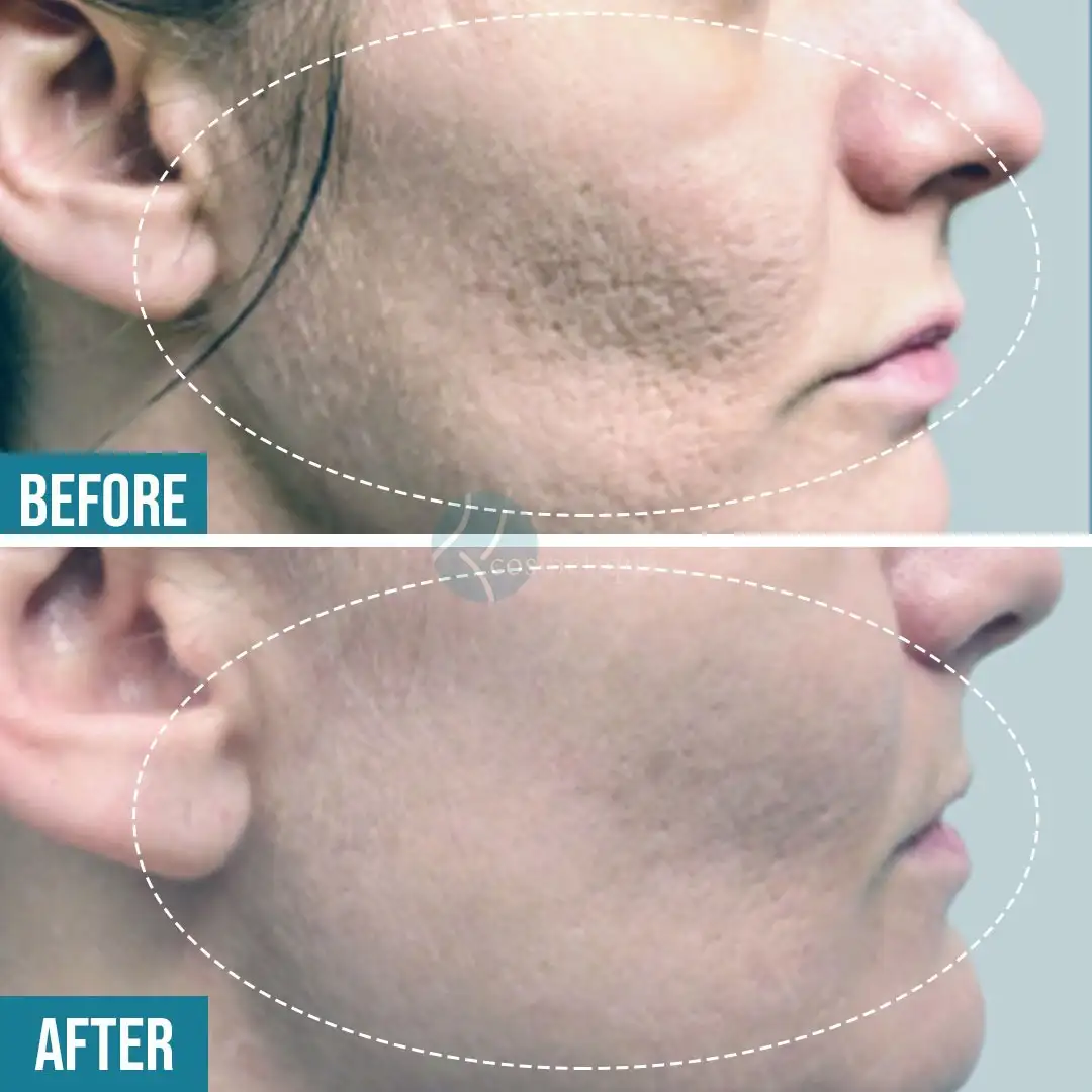 Gynecomastia Before After
