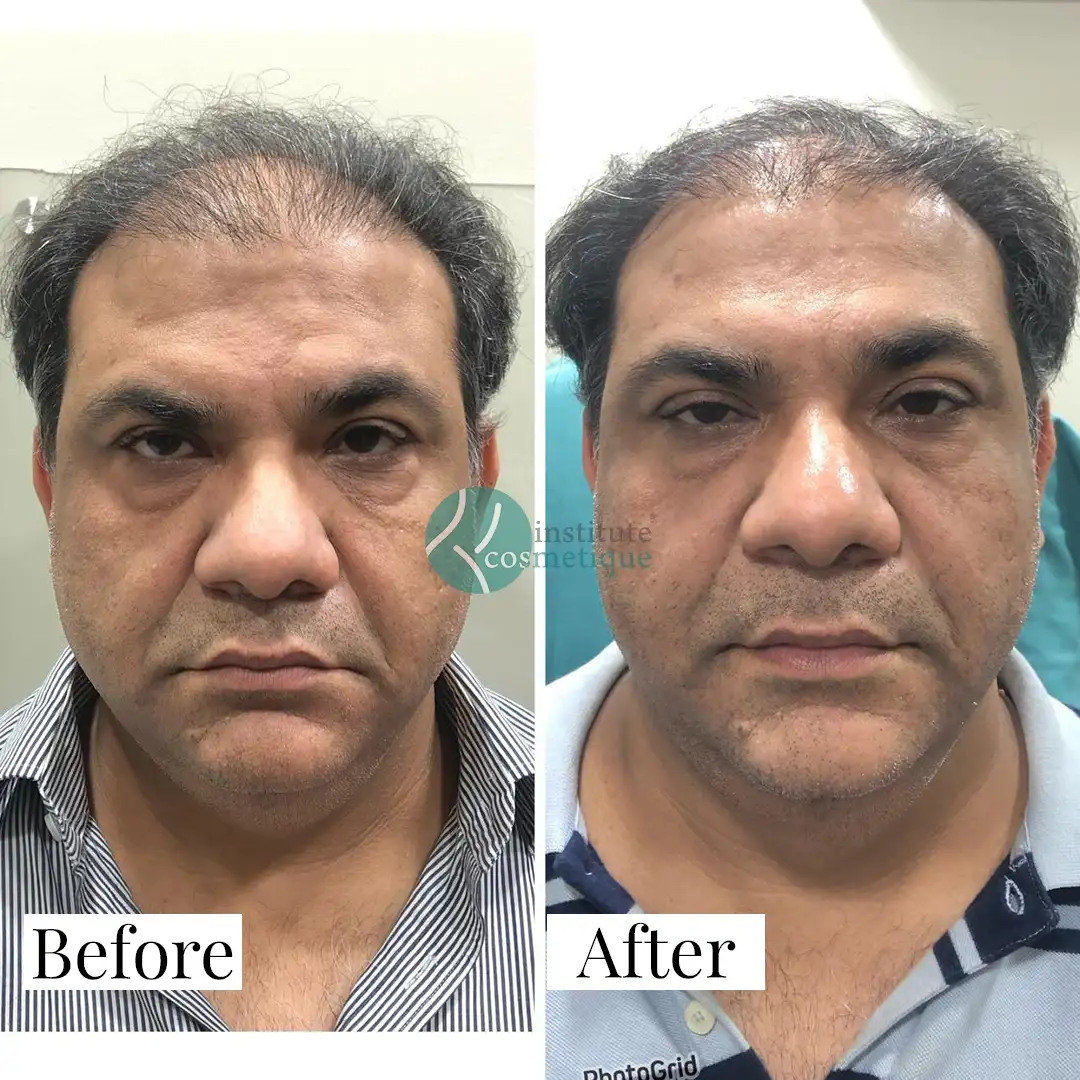 Gynecomastia Before After