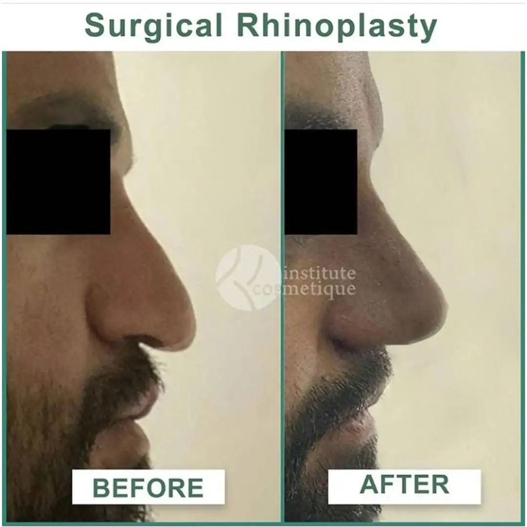 Cosmetic rhinoplasty results before and after treatment