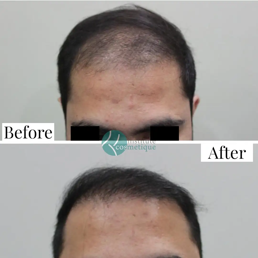 Before and after results of female hairline correction through hair transplant – best hair transplant in Pakistan.