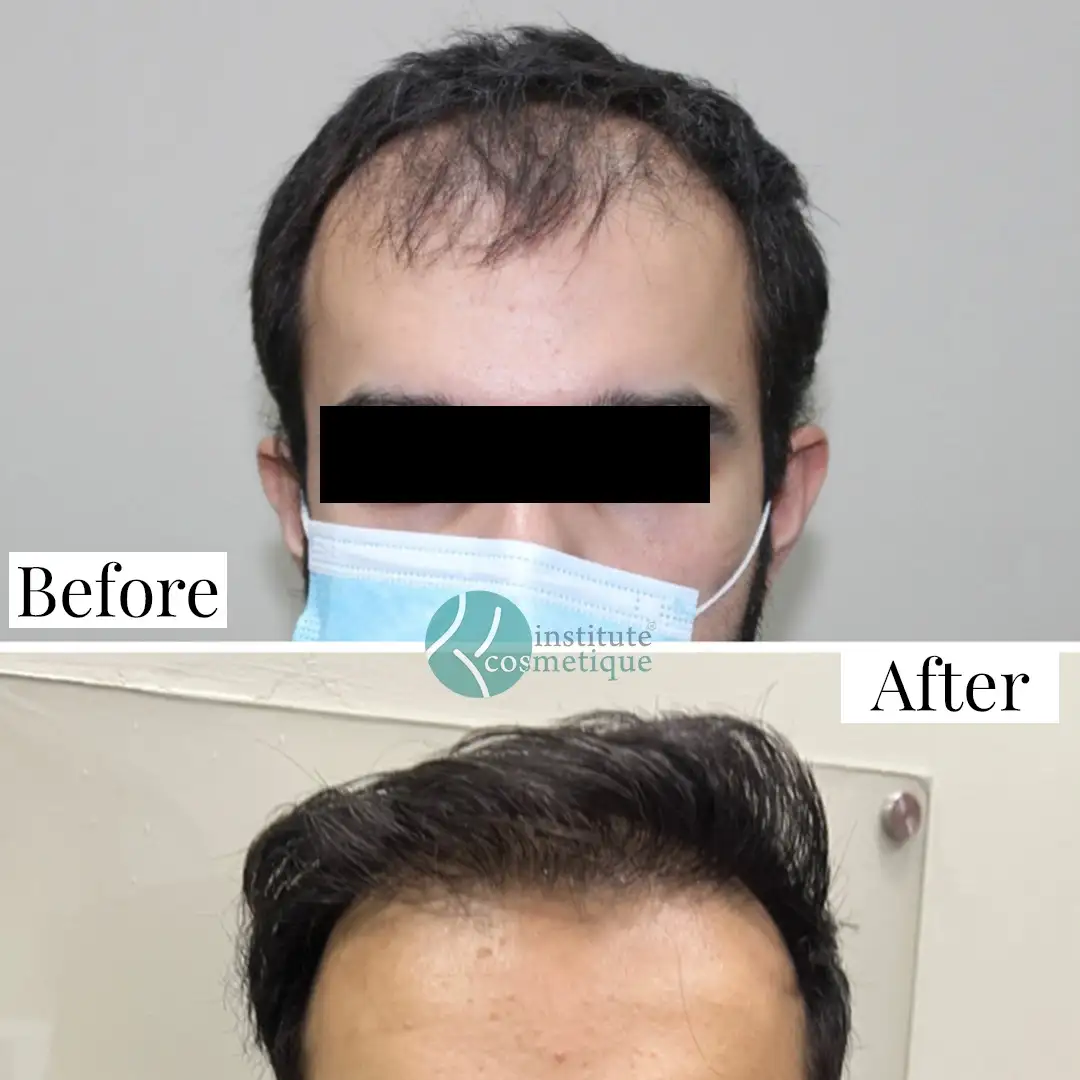 Before the procedure, hairline marking is visible. After one day, scalp healing with visible grafts is shown. After one week, hair growth and improved scalp condition are noticeable.