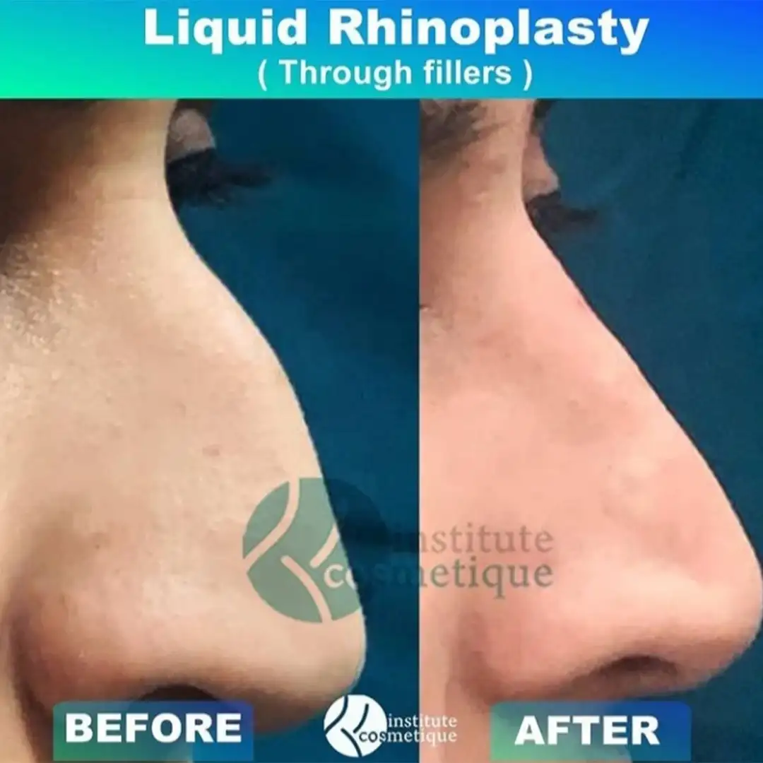 Functional rhinoplasty correction before and after images