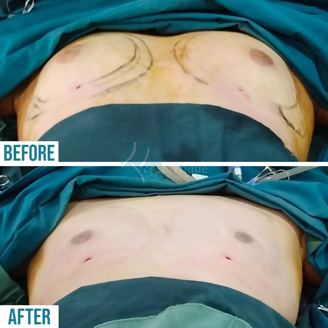 Gynecomastia Before After