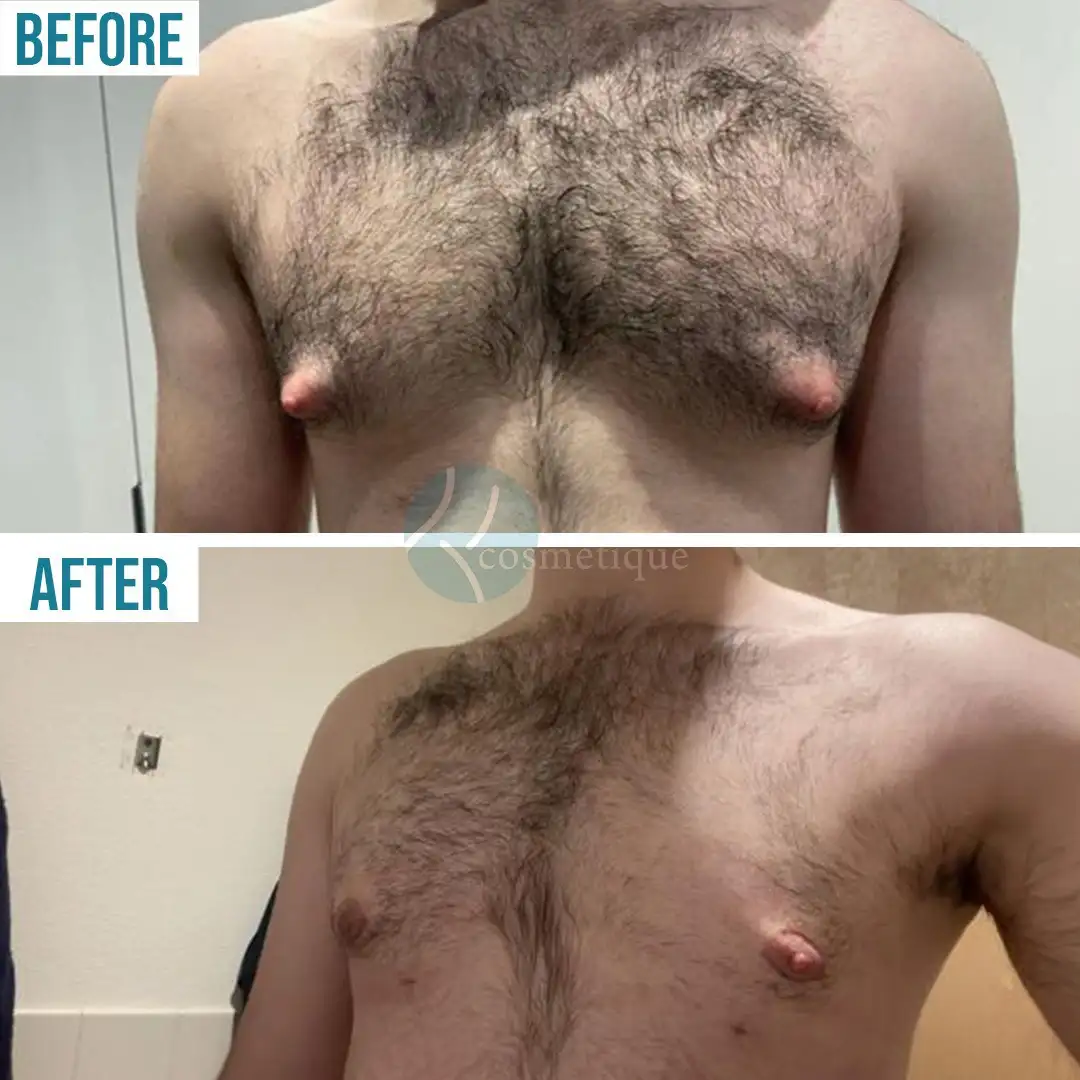 Gynecomastia Before After