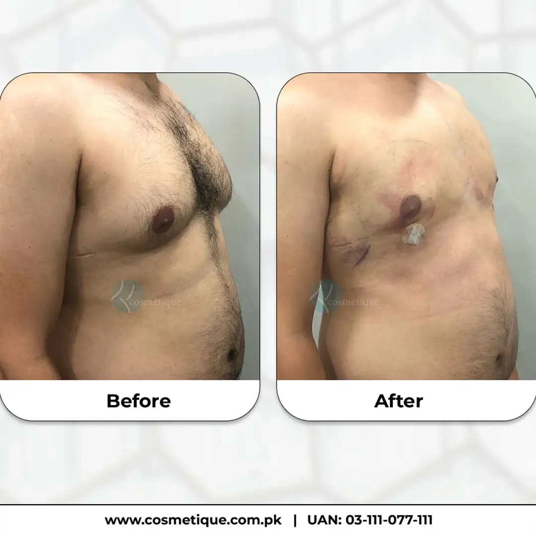Gynecomastia Before After