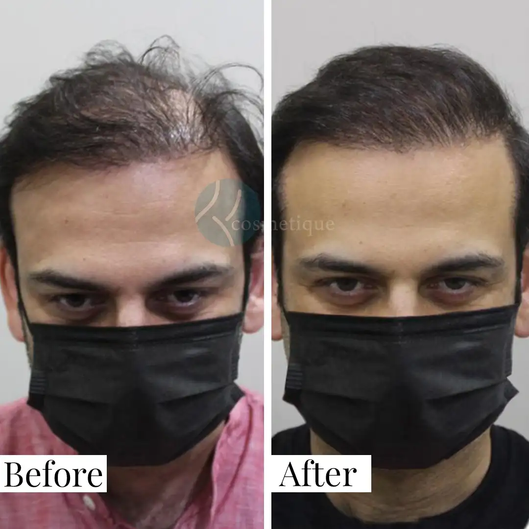 Before and after hair transplant results showing restored hairline and density – best hair transplant in Pakistan.