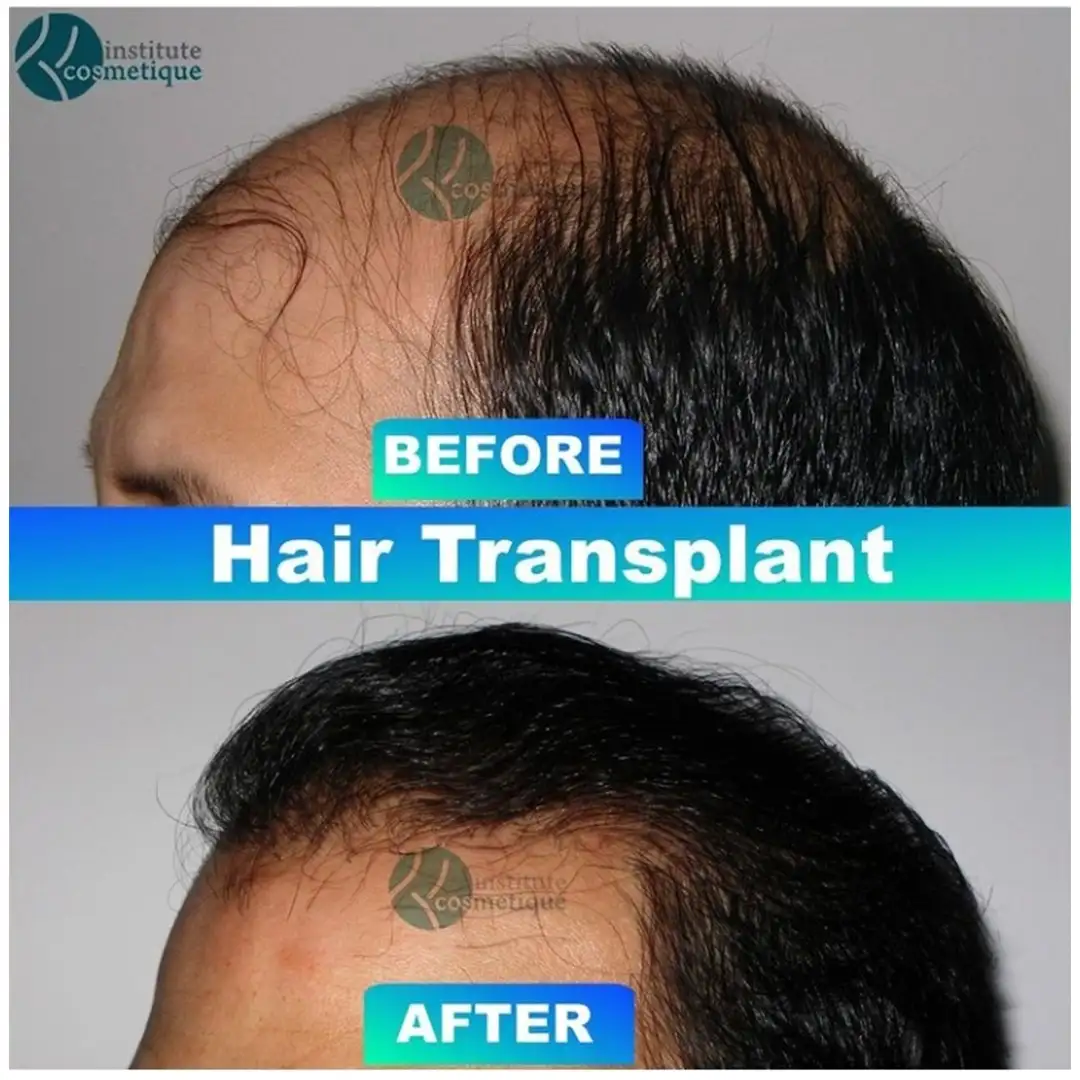 Best hair transplant in Pakistan - Before and after transformation displaying significant hair growth post-hair transplant.