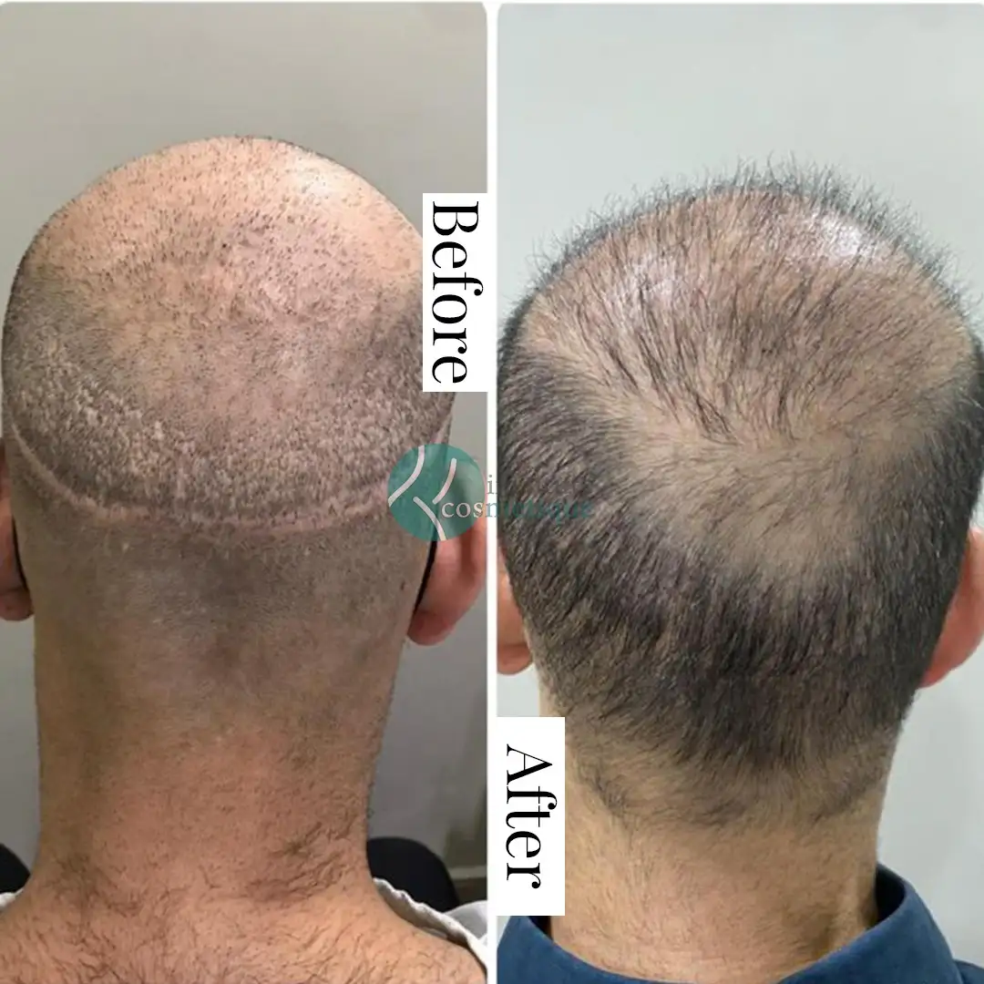 Best hair transplant in Pakistan - Before and after results showing hair transplant planning and initial graft placement.