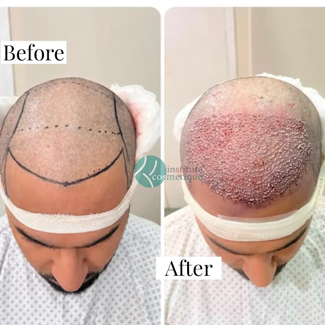 Progress photos of male hair transplant results from Dec 2019 to Dec 2021 – best hair transplant in Pakistan.