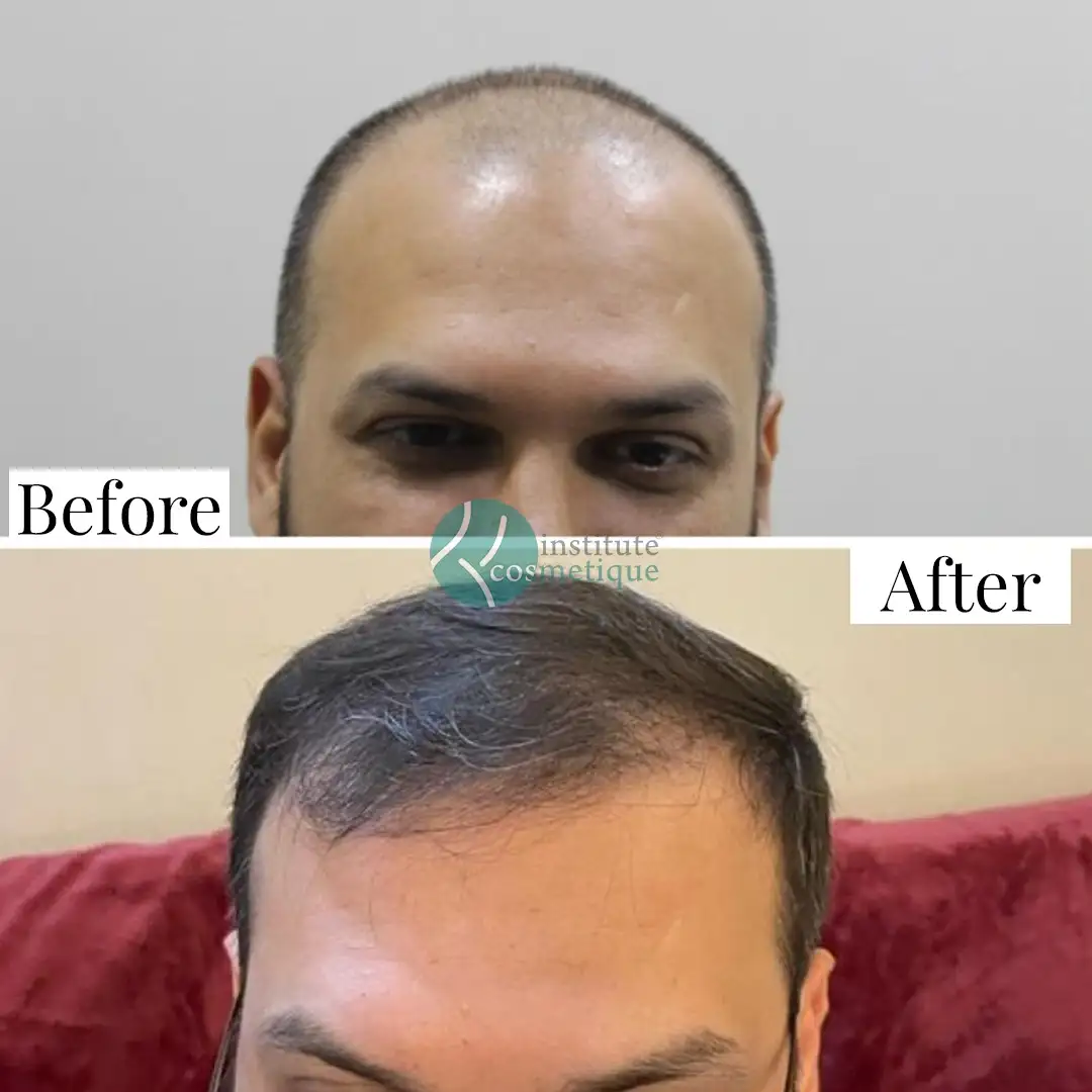 Before and after hair transplant results showing restored hairline and density – best hair transplant in Pakistan.