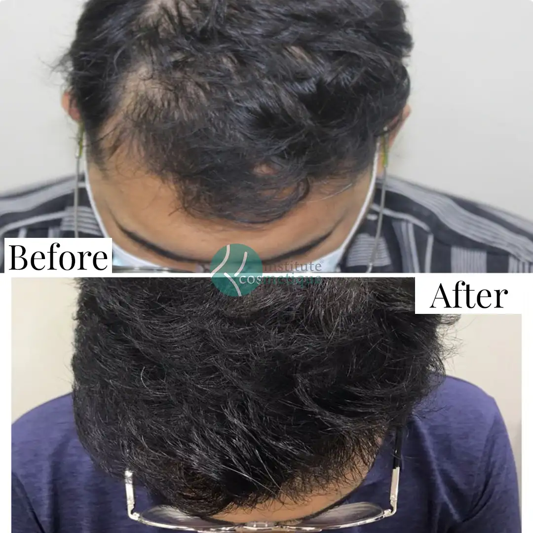 Best hair transplant in Pakistan - Before, during, and after stages of a hair transplant procedure with visible grafting results. 