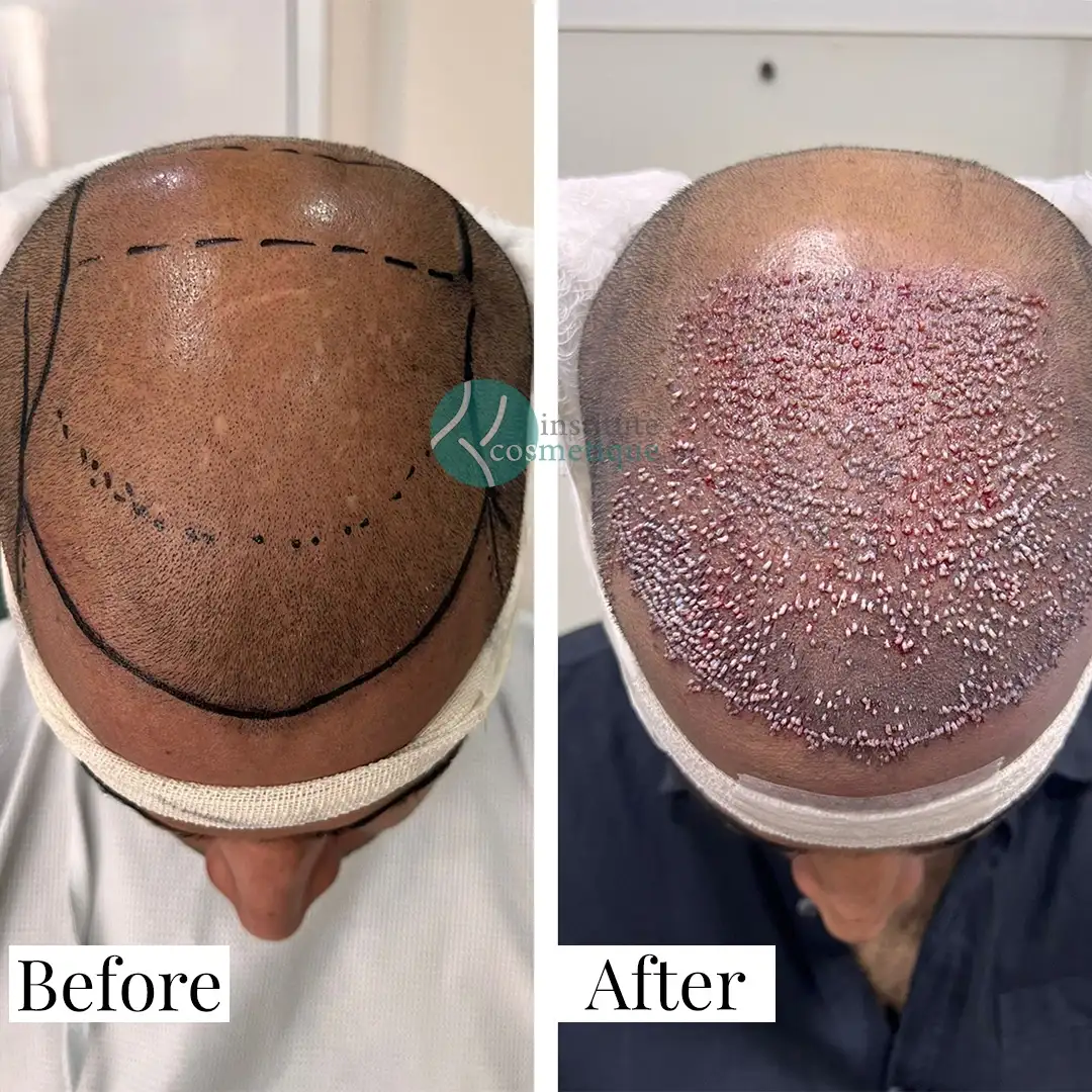 Hair Transplant Results Before and After - Before the procedure, hairline marking is visible. After one day, scalp healing with visible grafts is shown.