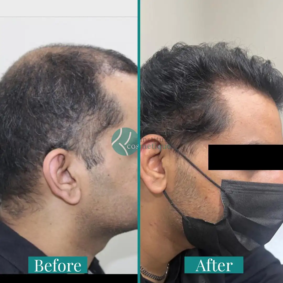 Hair Transplant Results Before and After - Before the procedure, hairline marking is visible. After one day, scalp healing with visible grafts is shown.