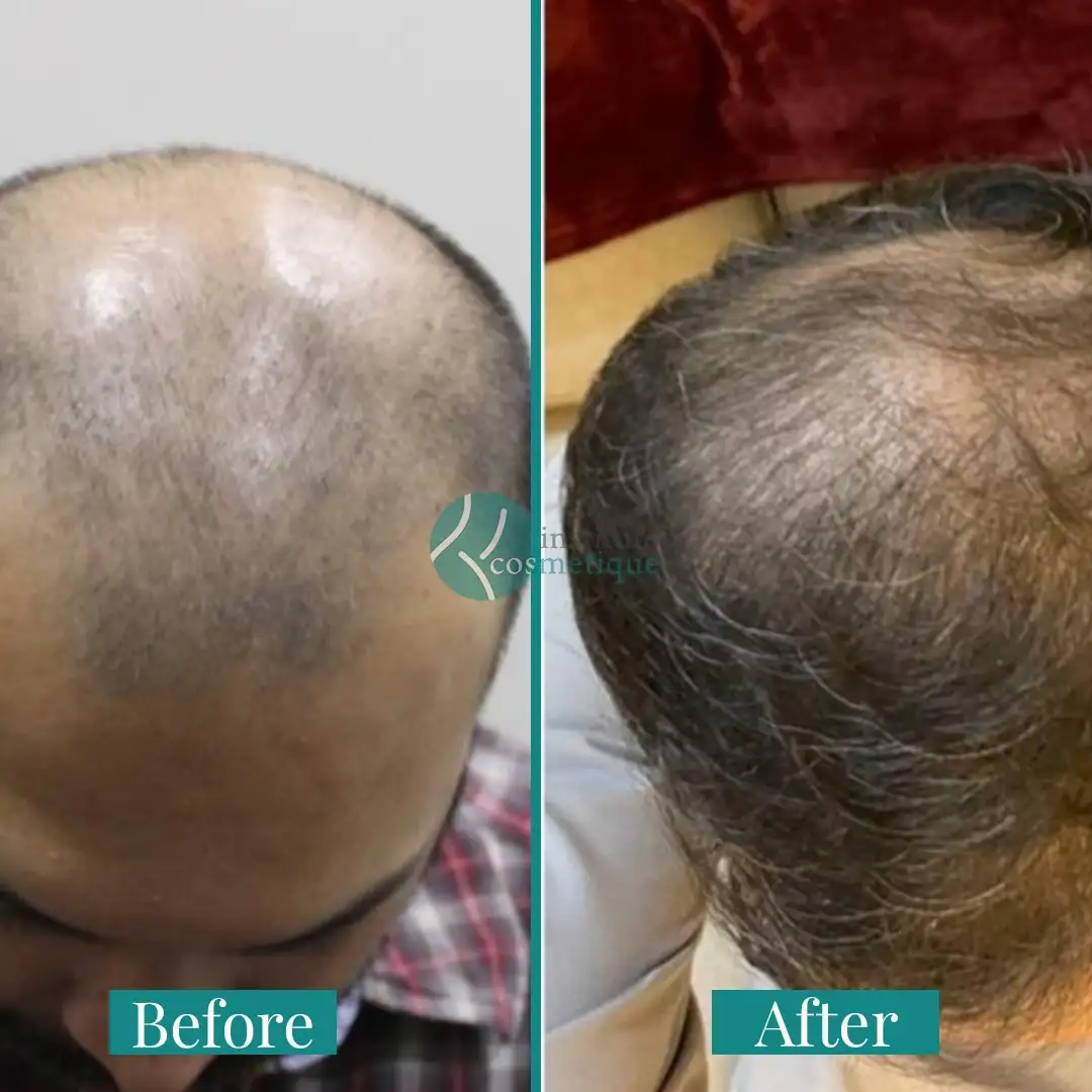 Hair Transplant Results Before and After - Before the procedure, hairline marking is visible. After one day, scalp healing with visible grafts is shown.