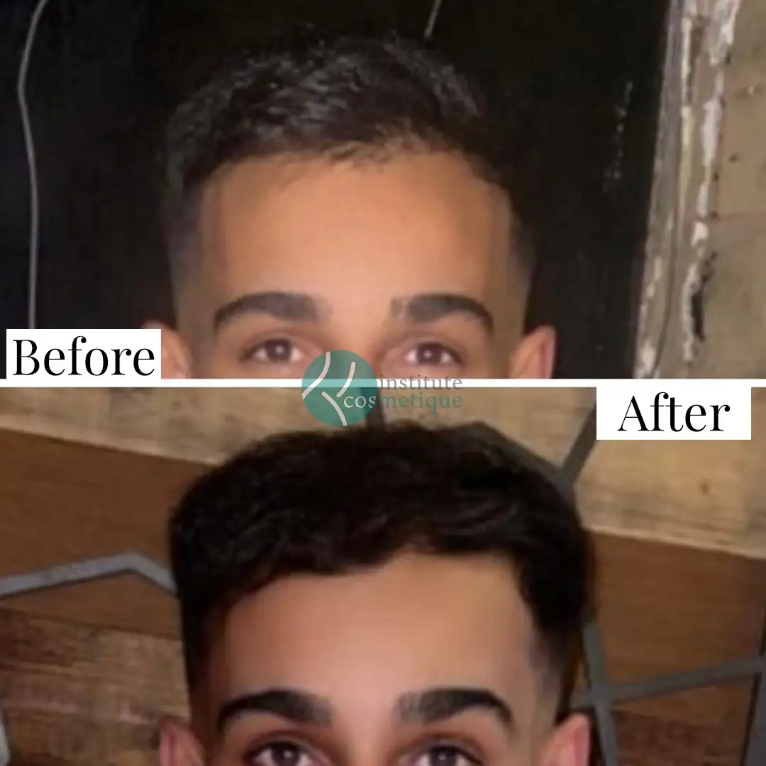 Hair Transplant Results Before and After - Before the procedure, hairline marking is visible. After one day, scalp healing with visible grafts is shown.