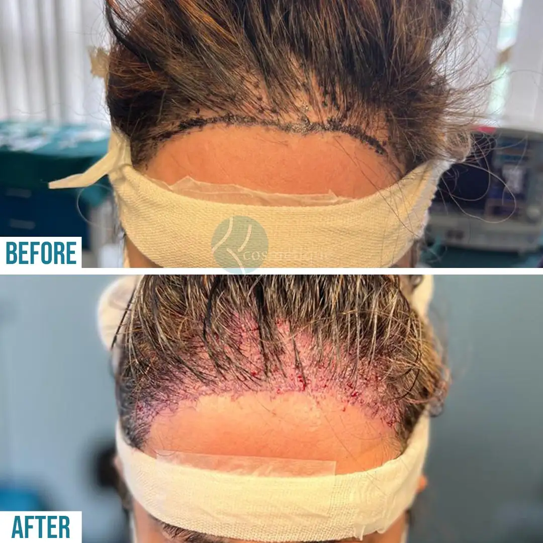 Hair Transplant Results Before and After - Before the procedure, hairline marking is visible. After one day, scalp healing with visible grafts is shown.