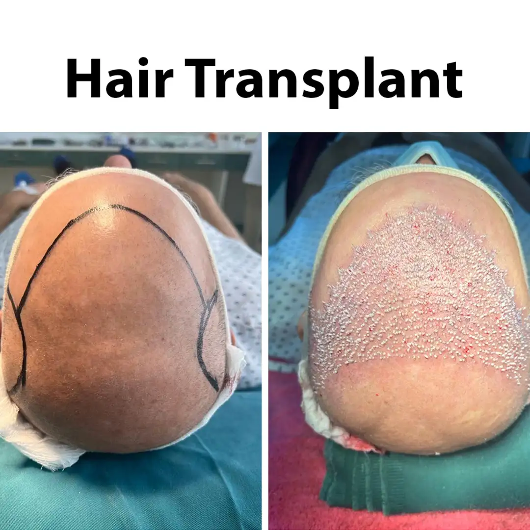 Hair Transplant Results Before and After - Before the procedure, hairline marking is visible. After one day, scalp healing with visible grafts is shown.