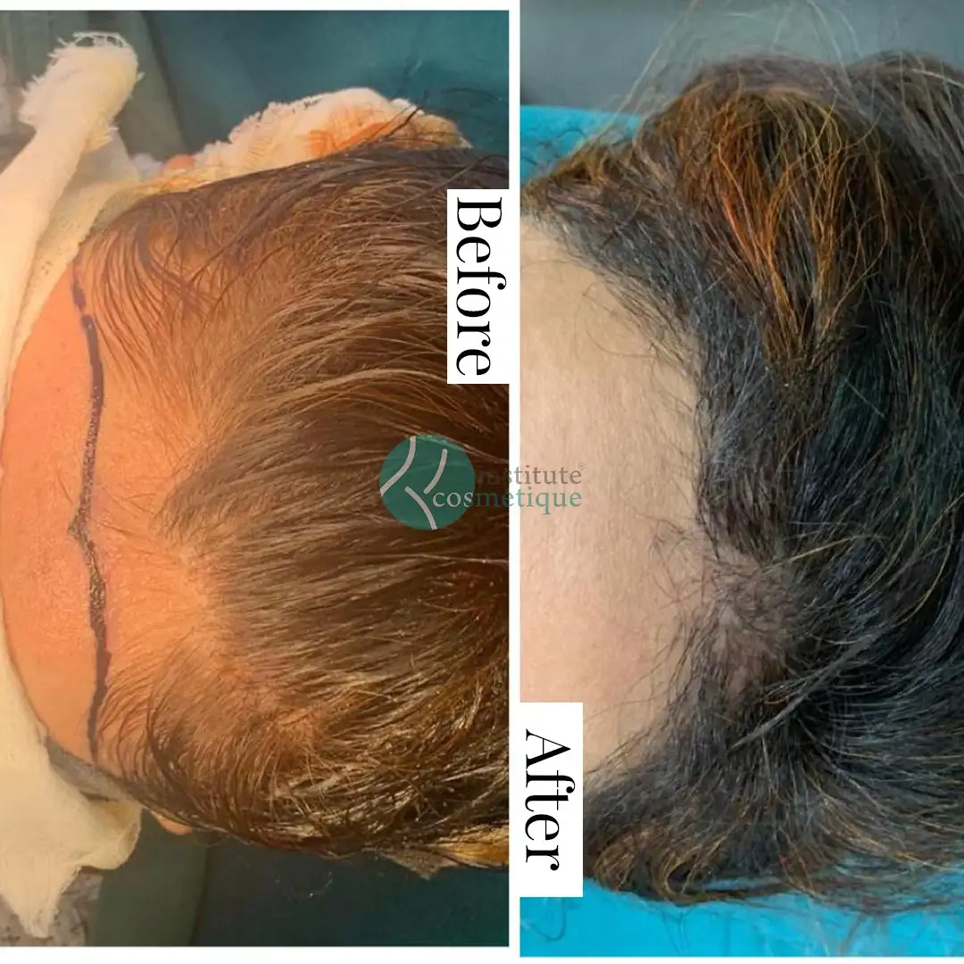 Hair Transplant Results Before and After - Before the procedure, hairline marking is visible. After one day, scalp healing with visible grafts is shown.