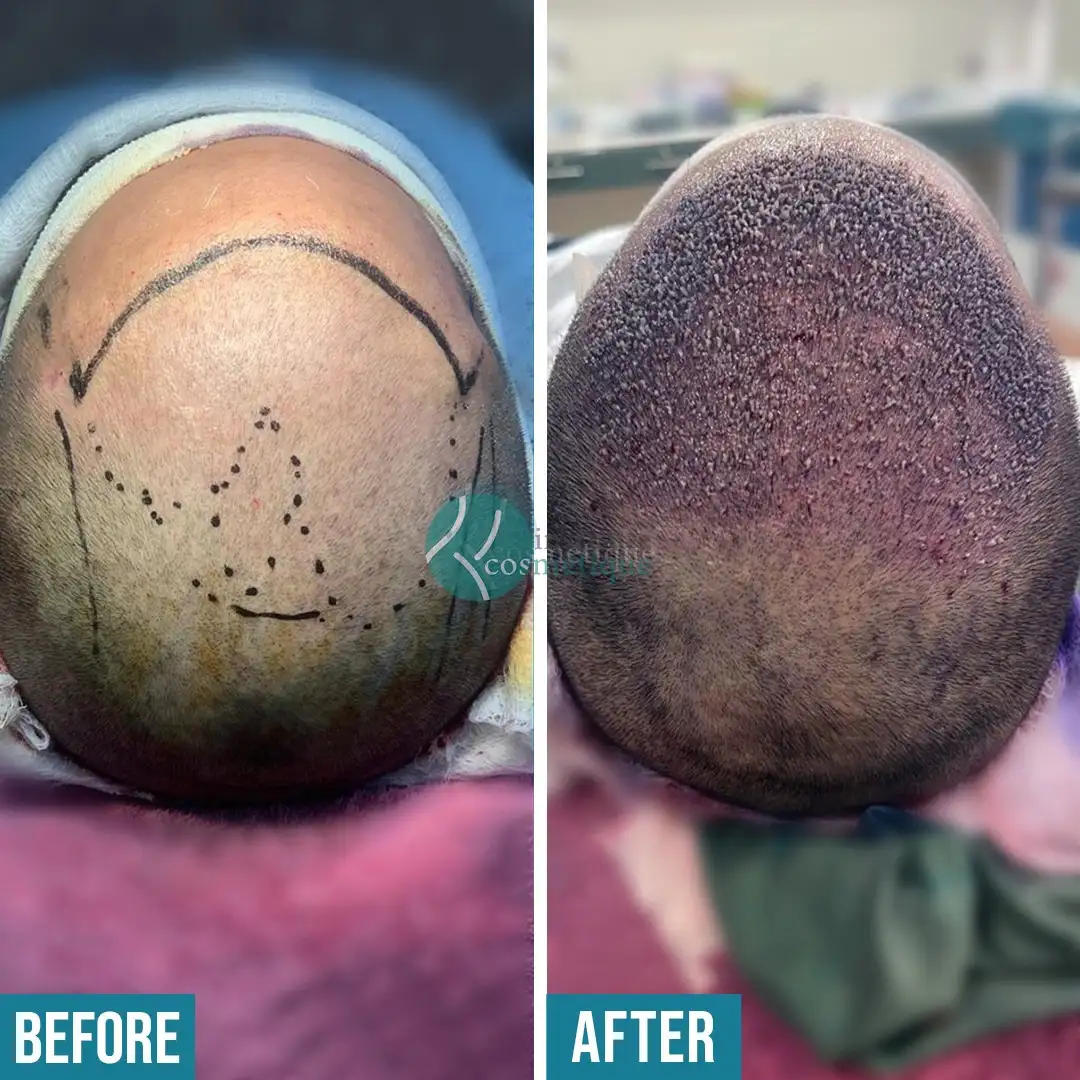 Hair Transplant Results Before and After - Before the procedure, hairline marking is visible. After one day, scalp healing with visible grafts is shown.