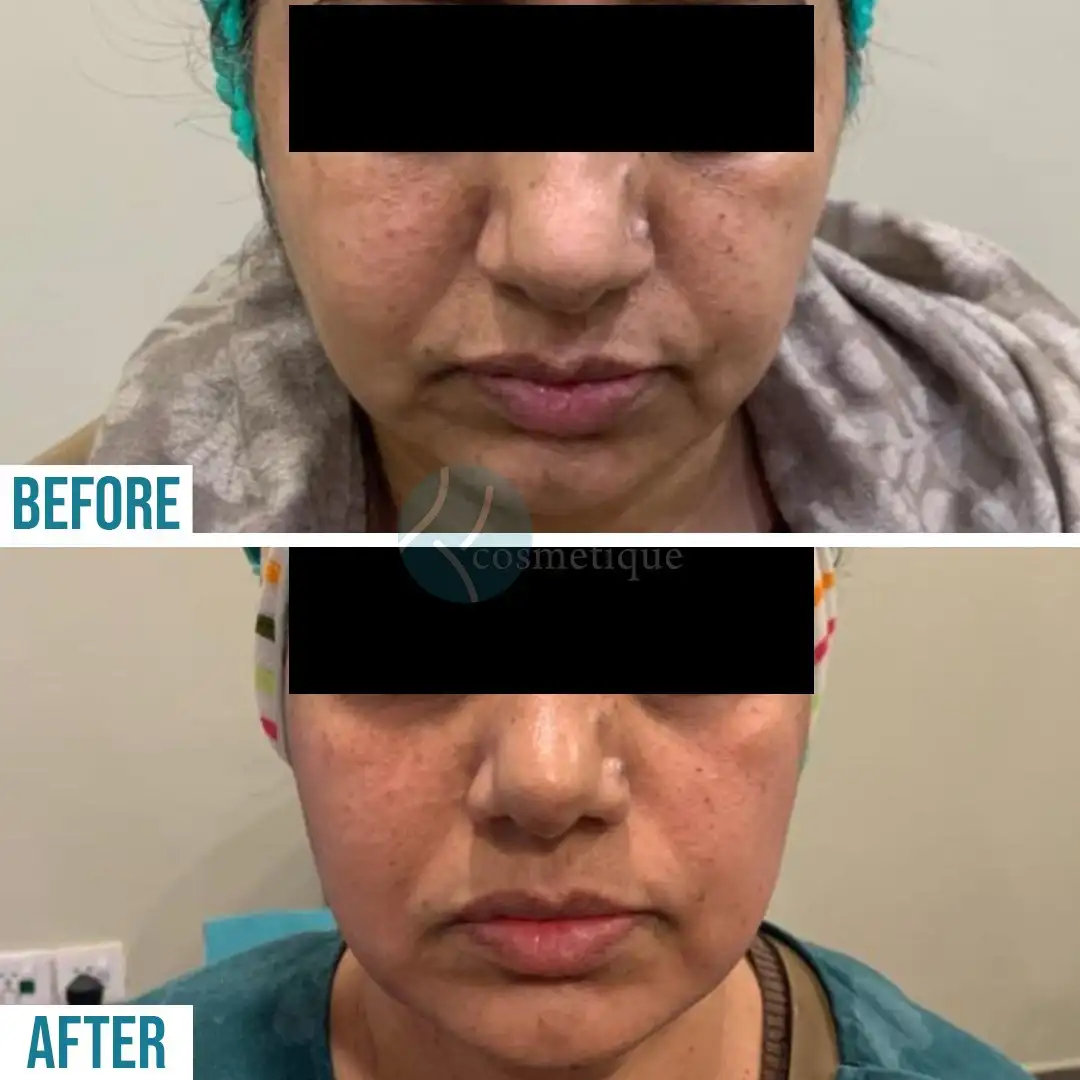 Gynecomastia Before After