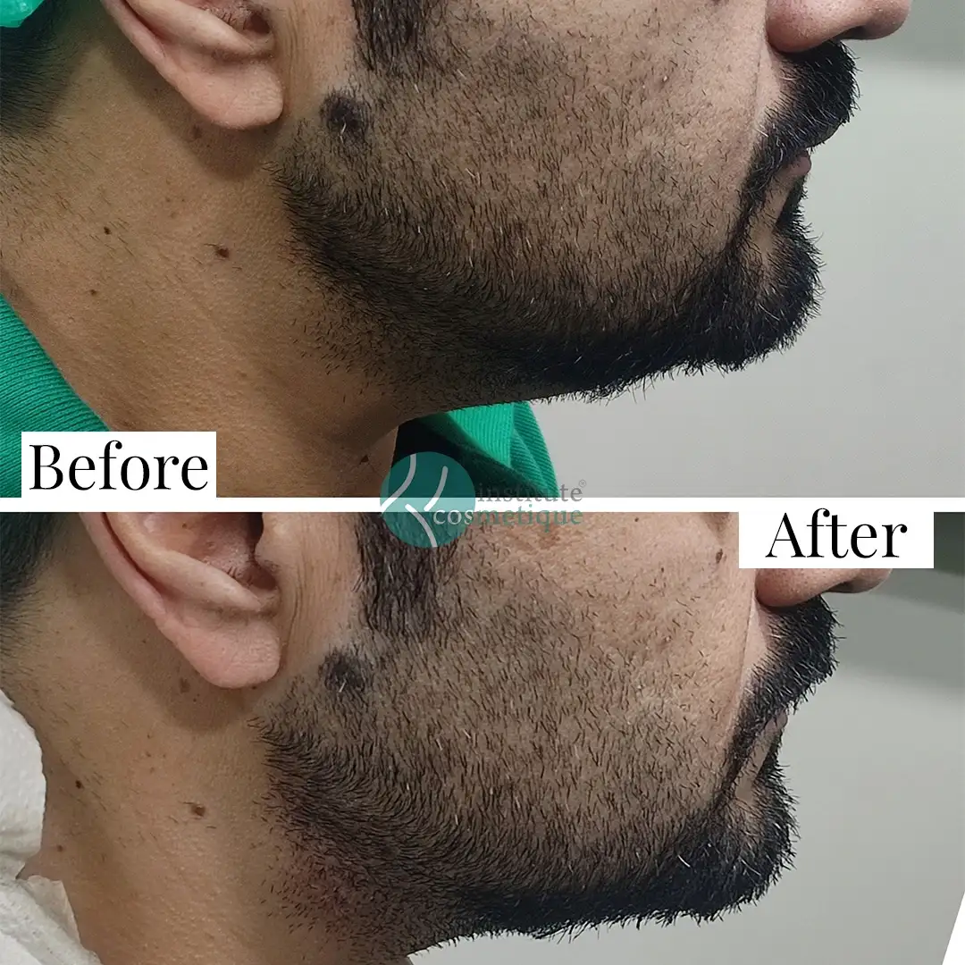 Gynecomastia Before After
