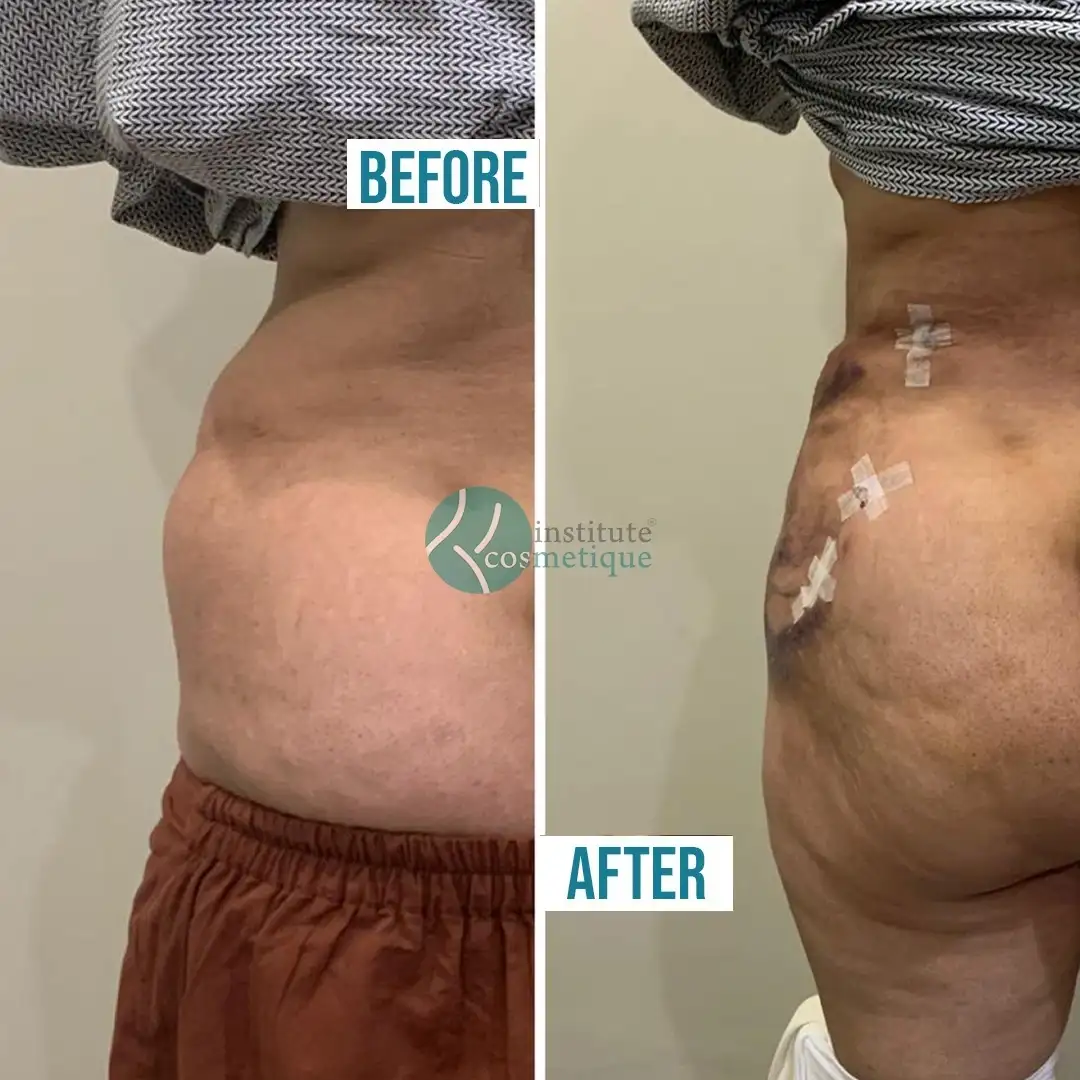 Liposuction body sculpting before and after results