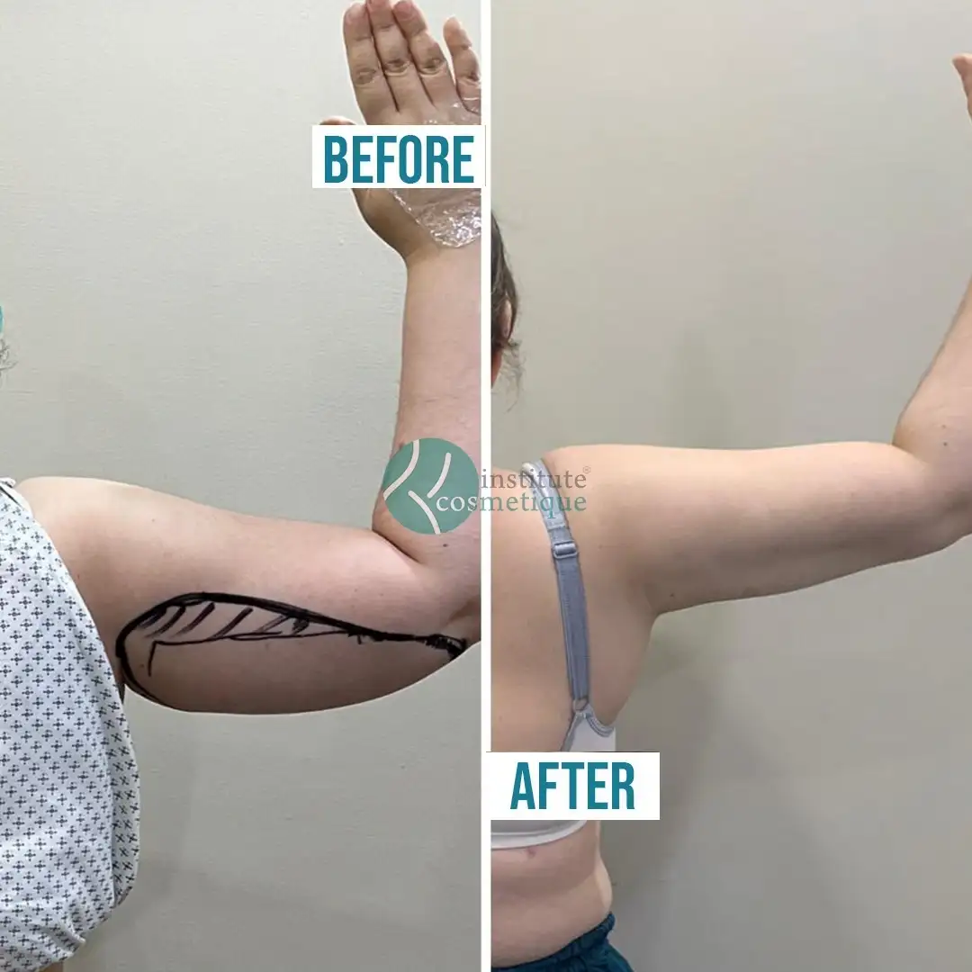 Liposuction contouring before and after results