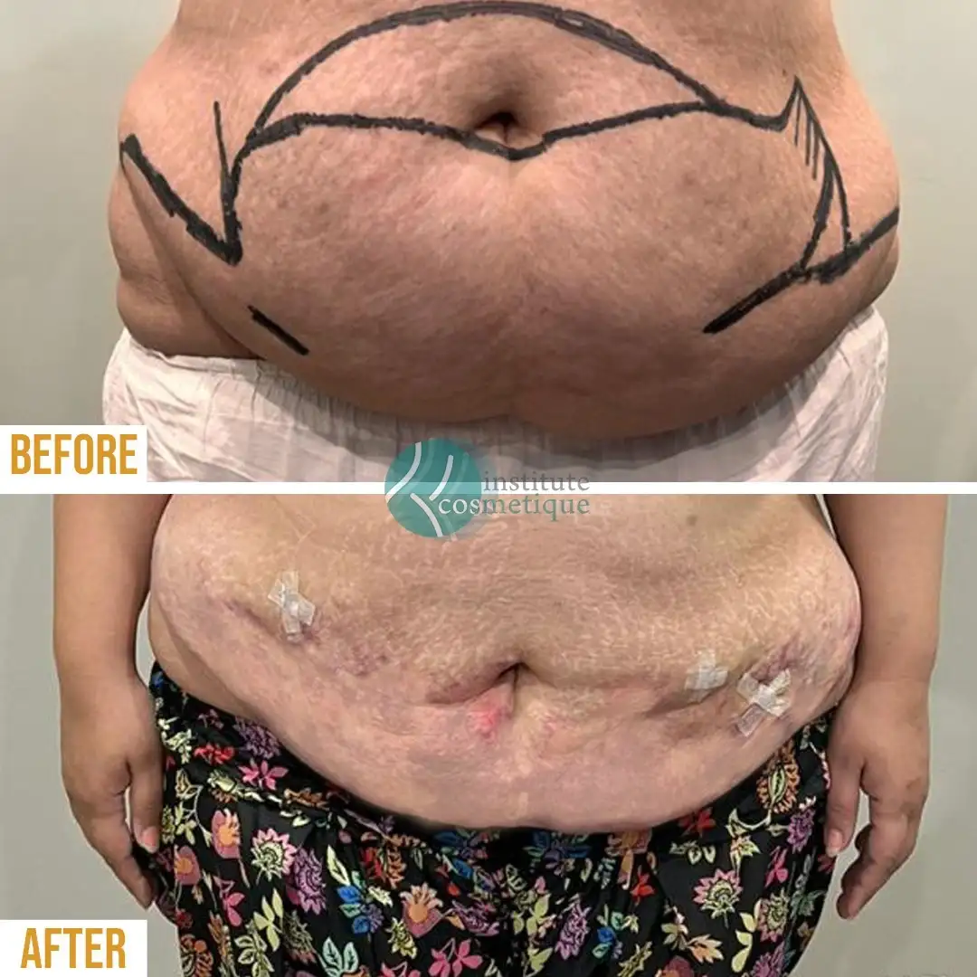 Liposuction cosmetic contouring before and after results