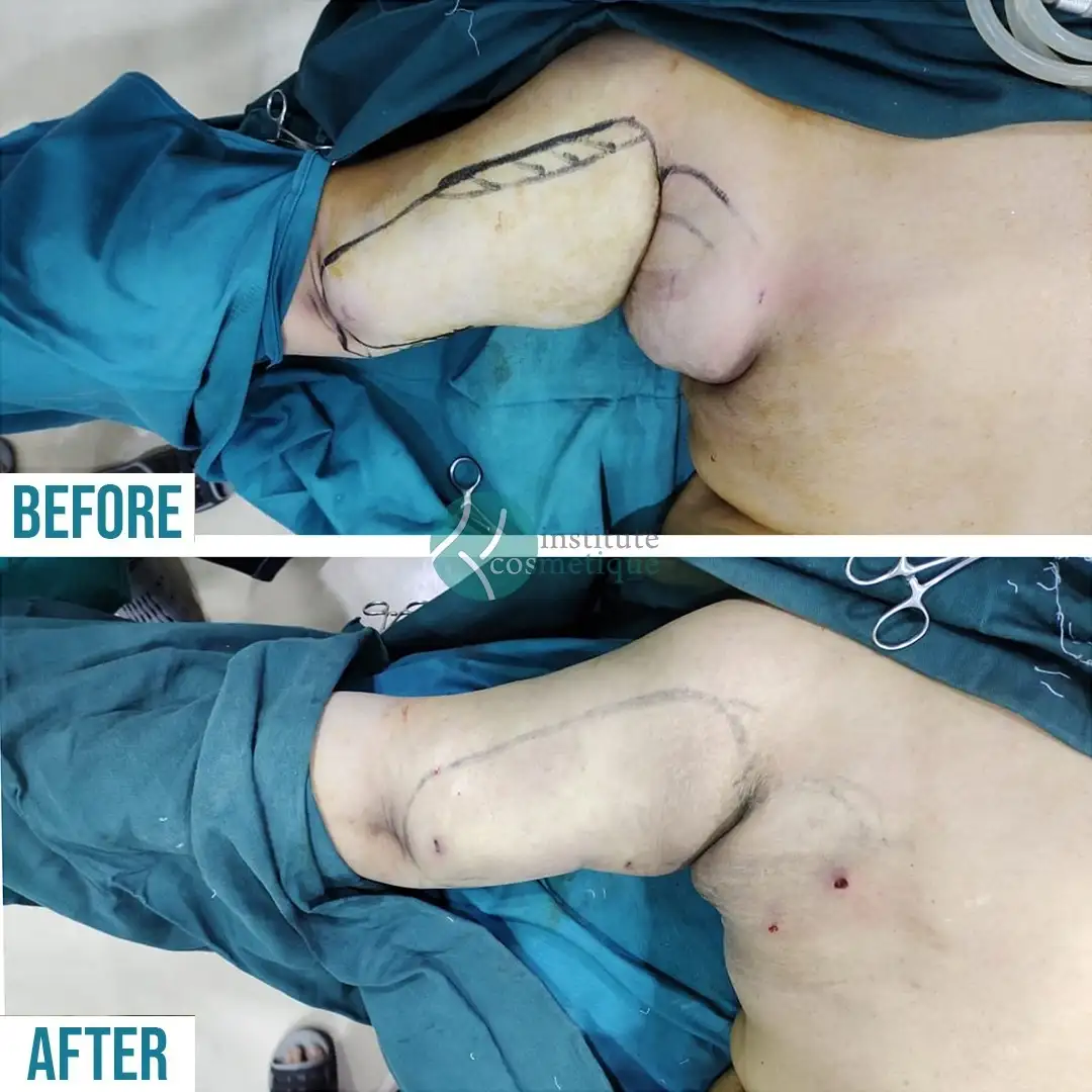 Liposuction figure improvement before and after results
