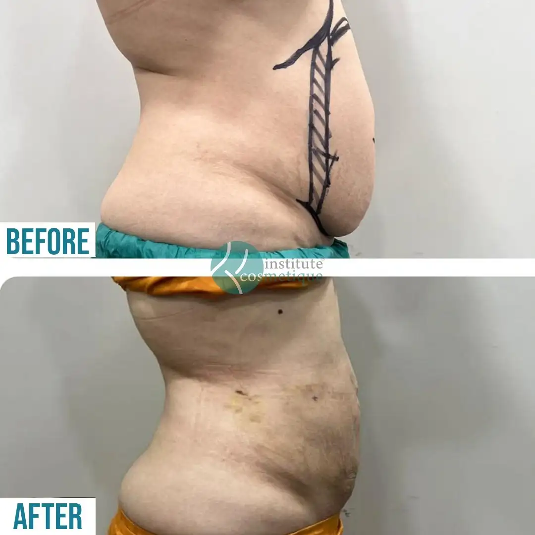 Liposuction slimming before and after results