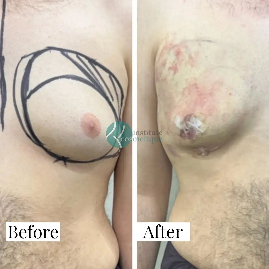 Gynecomastia Before After