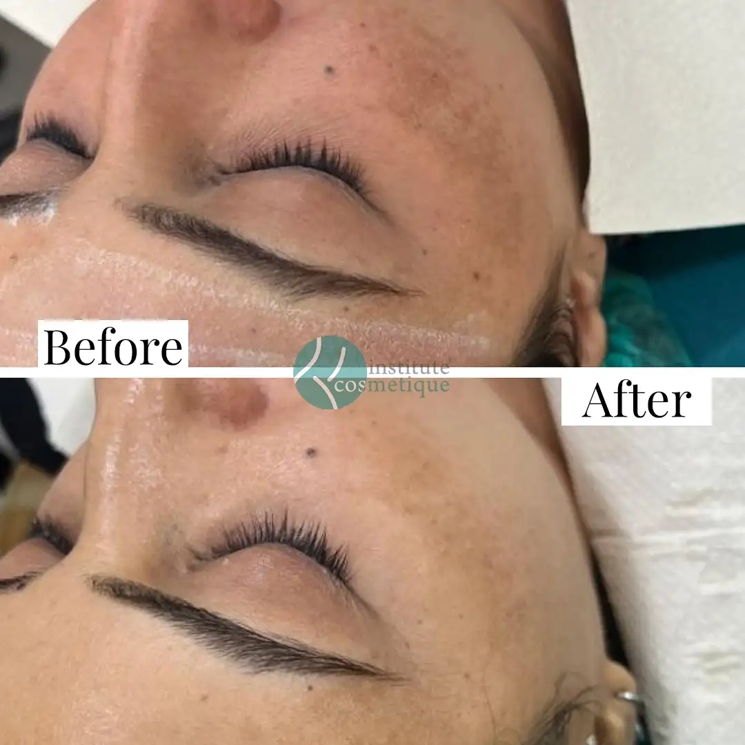 Microdermabrasion skin renewal before and after