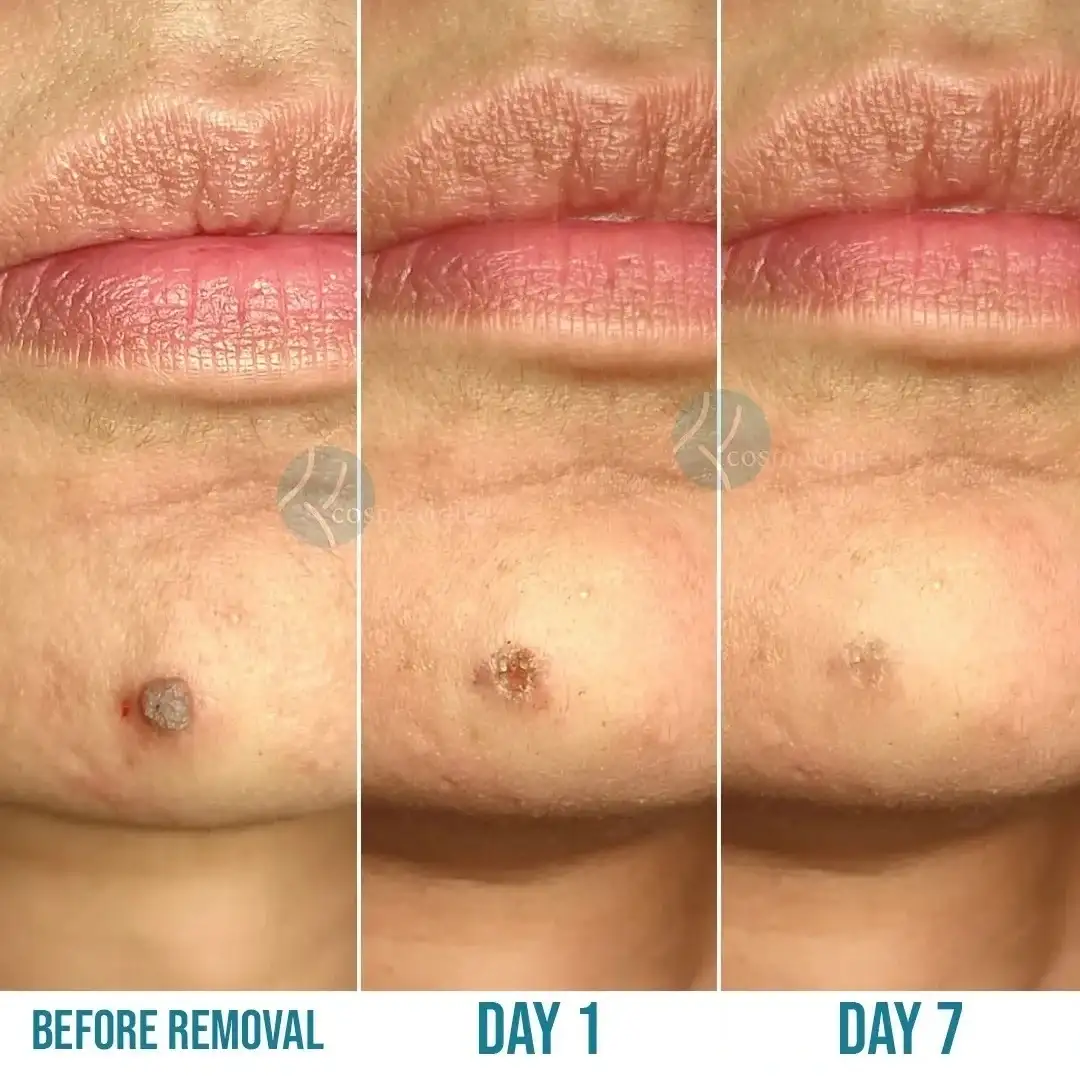Skin tightening and wrinkle reduction before and after HIFU therapy at Institute Cosmetique