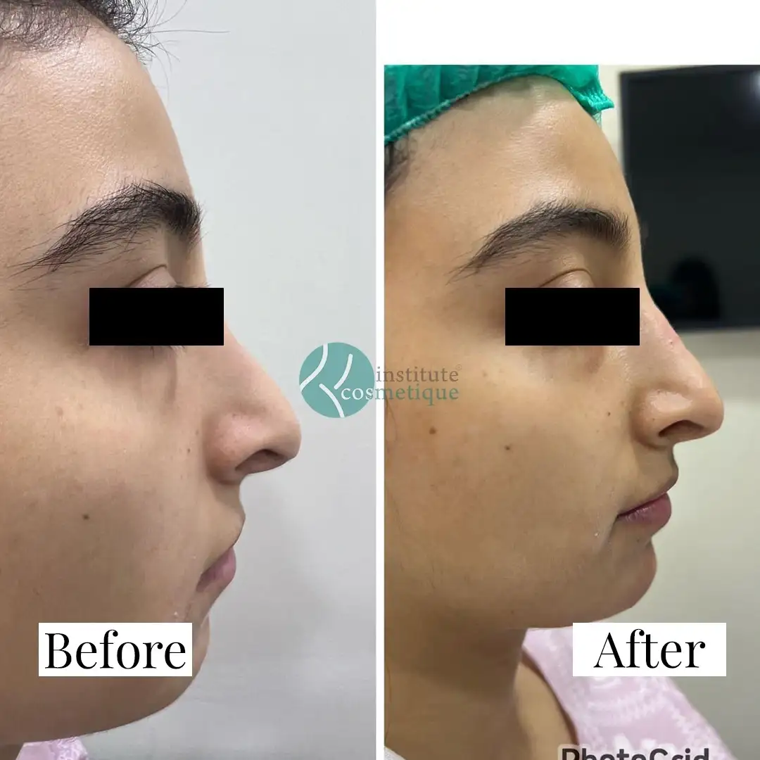 Nose surgery transformation before and after results