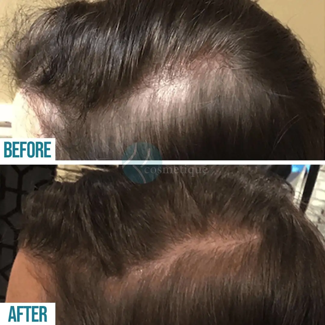 Platelet rich plasma therapy PRP before and after results